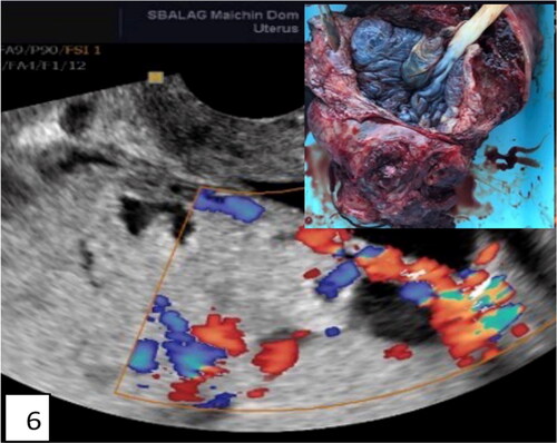 Figure 6. Ultrasound and pathohistological correlation of total placenta accreta in the lower segment. Lacunae, bridging vessels, and myometrial thinning on ultrasound with loss of anatomical space around the cervix, demonstrated on pathohistological specimen—hysterectomy of the uterus with avoiding of placental space (inset). The placenta is left in situ without separation.