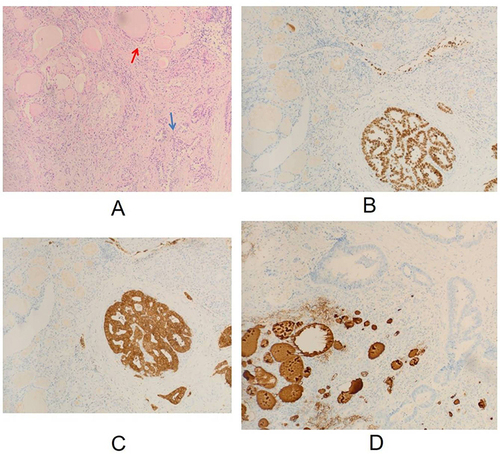 Figure 2 Immunohistochemistry revealed adenoid arrangement of heteromorphic cells with interstitial fibrosis. Immunohistochemistry revealed positive expression of CDX-2 (an intestinal specific transcription factor) and Villin, while negative expression of TG (thyroglobulin), suggesting a high possibility of intestinal metastatic adenocarcinoma. (A) The tumor cells (blue arrows) are adenoid and distributed in the thyroid tissue. And the thyroid follicles can be seen (red arrows); (B) The tumor cells were positive for CDX-2; (C) The tumor cells Villin were positive; (D) TG in thyroid follicles was positive and TG in tumor cells was negative.
