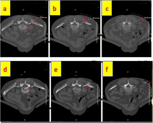 Figure 2 Based on the vertical CT scan images, we confirm the target point A, cross point B on the iliac crest and cross point C on the skin at the plane of L5/S1 (a). Because there will be obstruction by the iliac crest in the same plane, we will lift point C to reach the truly ideal puncture point A’ through cross point B’ on the iliac crest (b and c). The plasma puncture probe through A’ point slowly reached the A guided by different vertical CT scans plane (d–f).