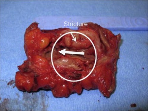 Figure 4 This is an endometriotic stricture >30% managed by segmental resection.