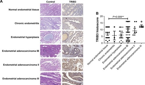 Figure 1 Immunohistochemical analysis of the expression of TRIB3 in control tissue and tissues with endometritis, endometrial hyperplasia, and endometrioid adenocarcinoma (stages IB, II, and III).Notes: (A) Representative examples of TRIB3 staining. TRIB3 staining was mainly localized in the cytoplasm. (B) Quantitation of immunohistochemical data. **P<0.01 by ANOVA.