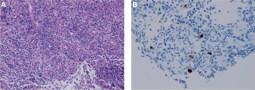 Figure 2 Histopathological findings. (A) Hematoxylin-eosin stained, 100×. (B) Immunohistochemistry for cytomegalovirus, 200×.
