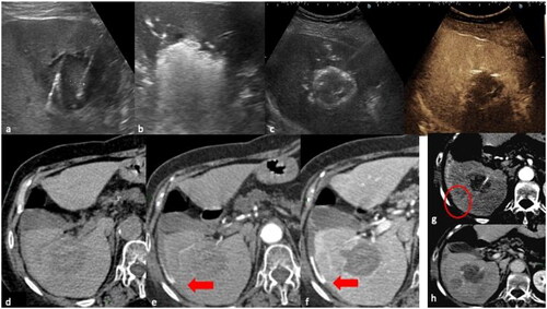 Figure 5. 78yo with liver metastasis of renal cell carcinoma treated with two microwave antennas. (a, b) US images highlighting the distance between the two probes and the hyperechoic bubbles during the ablation (c) Contrast-enhanced US exam displaying the complete devascularization of the lesion at the end of the procedure. (d) Unenhanced, (e) arterial and (f) portal CT scan images performed at the end of the procedure showing a subcapsular hemorrhage (arrow). (g) Cauterization of hepatic capsular access at 90° for 3 min was performed (circle). (h) Good local bleeding control at the CT scan after 48 h.
