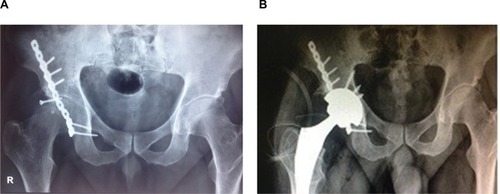 Figure 3 (A) Radiograph of an 18-year-old man who sustained a posterior wall acetabular fracture and was treated with Recon plate. (B) The conversion THR surgery after posttraumatic arthritis after 12 years of internal fixation.