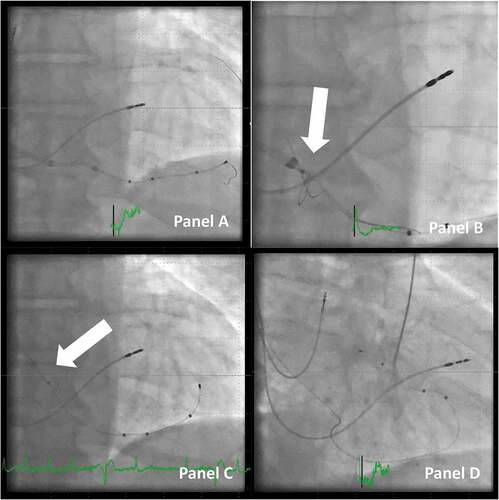Figure 7. Delivery of a lead to the final position with the use of the snaring technique. Panel A: CRT in a patient in whom it was not possible to enter a posterolateral target branch. Instead, the middle cardiac vein was used, and collaterals connected it to the target vein as well as the anterior. A quadripolar lead was delivered using the OTW technique. Panel B: A snare catheter is inserted, and the tip of the guidewire is snared (arrow). Panel C: the looping guidewire between the lead and the snare is tightened with a pull on the snare, and the lead is advanced forward. Note that the tip of the outer coronary sinus guide is retracted to the right atrium (arrow), so the snare catheter is not pulled back into the coronary sinus guide and thus bending of the guidewire is avoided. Panel D: final position of the lead in the posterolateral position with the snare removed.
