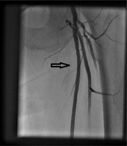 Figure 3 Angiogram showing no significant disease in left superficial femoral artery (arrow) after SilverHawk atherectomy and balloon angioplasty.