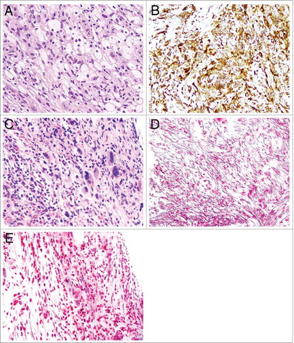 Figure 1. Microphotography of Erdheim Chester disease (ECD) and bone marrow fibrosis. A-B: There are numerous bland foamy histiocytes with abundant pale to clear cytoplasm (A) with immunoreactivity for CD68 (B) (original magnifications for A and B are 200x and 200x, respectively); C: The bone marrow core biopsy shows megakaryocytic hyperplasia, atypia and cellular streaming, indicative of fibrosis (original magnification 200x). D-E: Reticulin (D) and Trichrome (E) special stains show markedly increased reticulin fibrosis (D) and rare bundle of collagen (blue, E) (original magnifications of D and E are 200x and 200x, respectively).