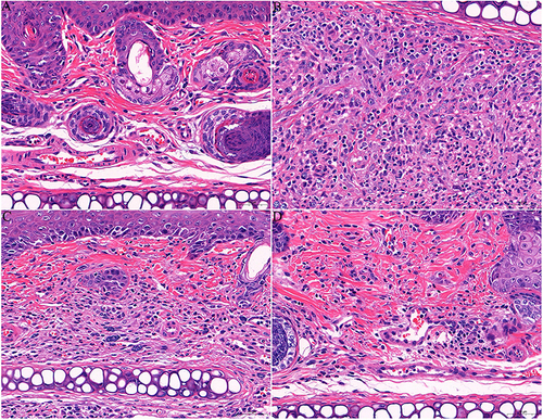 Figure 2 Skin histopathology among the these groups (hematoxylin-eosin, 400 × magnification). (A) control group; (B) acne model group, Collagen fibrodegenerative necrosis (↑) Neutrophils (↑) Lymphocytes (↑) Fibroblasts (↑); (C)IDDS treatment group, Collagen fibrodegenerative necrosis (↑) Neutrophils (↑) Lymphocytes (↑) Fibroblasts (↑); (D)positive drug controlled group, Collagen fibroblast degeneration (↑) Lymphocyte (↑) Fibroblast (↑).