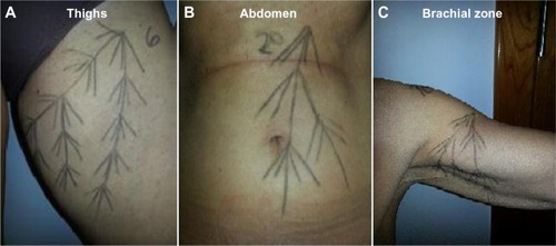 Figure 1 Examples of a vector map for injection in (A) thighs, (B) abdomen, and (C) brachial zones.