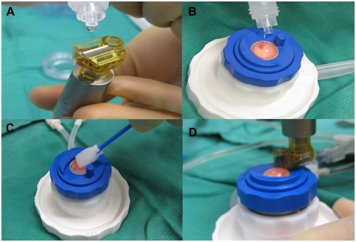 Figure 4 Prior to the initial pass, the microkeratome head is lubricated and checked for oscillations (A). A drop of balanced salt solution is placed on the guide ring near the docking site of the head (B), and a wet Weck-cell is used to gently moisten the cornea surface prior to the first cut (C and D).
