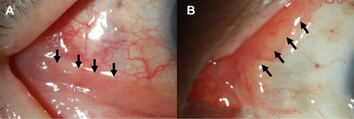 Figure 4 Slit-lamp images of conjunctival MALT lymphoma in Case 14. Slit-lamp images of conjunctival MALT lymphoma (arrows) in the right (A) and left eyes (B) in Case 14. Conjunctival salmon-pink lesions were found at the lower palpebral conjunctival fornix in the right eye and in the superior and medial bulbar conjunctiva in the left eye.