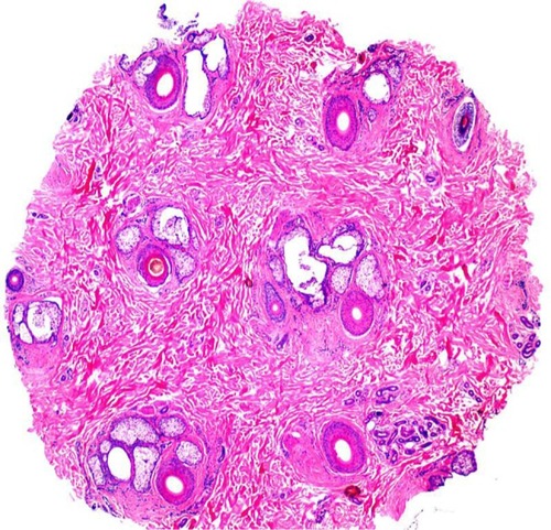 Figure 8 Histology of traction alopecia. On horizontal sections at the level of the isthmus, there is an overall preserved follicular architecture but significantly reduced follicular density (total of nine follicles). The terminal: vellus ratio is 2:1. The sebaceous glands are mostly preserved (hematoxylin and eosin, ×2).