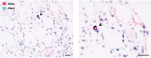 Figure 3. NGAL expression in the blood vessels of salivary glands from patients with pSS. Double immunohistochemical staining utilising NGAL (pink) and PNAd (green); for the detection of high endothelial venules, confirms NGAL expression in some of the blood vessels within the pSS target organ. The arrowheads indicate a double-positive blood vessel expressing both NGAL and PNAd.