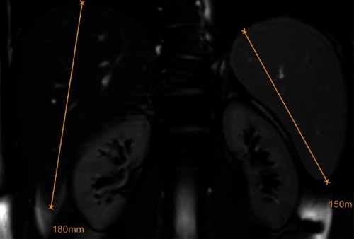 Figure 4 Hepatosplenomegaly. In LAL-D, the relative degree of hepatomegaly is usually prevalent over the relative degree of splenomegaly. The exclusion of hematological disorders should prompt the work-up for inherited storage disorders.Abbreviation: LAL-D, lysosomal acid lipase deficiency.