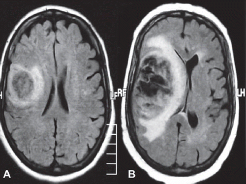 Figure 1. A. Magnetic resonance imaging of the primary tumor at the baseline; B. progressive disease after two cycles of Temozolomide therapy.