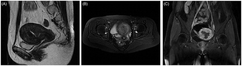 Figure 4. MRI image obtained from the patient with DUL 6 months after HIFU treatment. The sagittal (A), transverse (B) and coronal (C) T2WI revealed a significant uterine volume reduction and a uterus with nearly normal anatomical structure 6 months after HIFU.