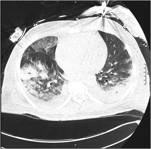 Figure 2. Axial section CT non-enhanced (lung window), section 60, obtained in the emergency department demonstrating ground glass infiltration. L = Left side, A = anterior, P = posterior, scale = 1cm. Figure 1