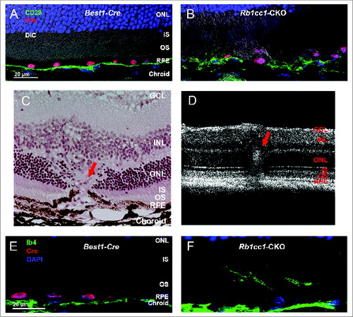 Figure 6. Loss of autophagy in the RPE results in disruption of the normal interface with Bruch's membrane. (A, B) Staining of retinal sections with an antibody against CD29, a component of the ITGB1/integrin β-1 complex and a marker of the basal surface of the RPE, shows disruption of the normally continuous linear structure. (C) Histological section of a retina from an 8-mo-old Rb1cc1-CKO mouse shows a focus of vascular ingrowth from the choroid through the RPE and into the retina (red arrow), consistent with a focus of choroidal neovascularization. (F) This finding was also seen on OCT imaging of the retina (red arrow). (E, F) Staining with the vascular marker, IB4, confirms that the ingrowth contained blood vessels. GCL, ganglion cell layer; INL, inner nuclear layer; IS, inner segment; ONL, outer nuclear layer; OS, outer segment; RPE, retinal pigment epithelium.