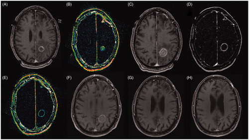 Figure 2. Images of 67-year-old male patient with a brain metastases recurrence after SRS from non-small cell lung cancer. (A) Pre-ablation axial T1C + MRI showing a deep seated ring enhancement in the left parietal lobe, compatible with recurrent tumor; (B) Pre-ablation Dynamic Contrast-Enhanced k-trans MR showing a high signal intensity inside the lesion suggesting high vascularization; (C) Post-ablation axial T1C + MRI showing the classic eggshell enhancement in the borders of the ablation; (D) Post-ablation MRI subtraction compatible with complete ablation; (E) Post-ablation axial Dynamic Contrast-Enhanced k-trans MR showing low signal intensity compatible with no viable tissue within the ablation zone; (F) One month post-ablation axial T1C + MRI showing eggshell enhancement and no signs of local recurrence; (G) Three month post-ablation axial T1C + MRI without local recurrence; (H) Six month post-ablation axial T1C + MRI with only remnant signs of ablation.