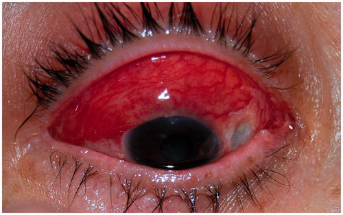 Figure 2. Relapse of inflammation.