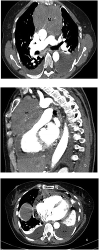 Figure 2. CT chest angiogram in figures 2 (a) and (b) showing mildly lobulated, mildly heterogeneously enhancing anterior mediastinal mass measuring approximately 9.5 × 6.7 x 10.0 cm. The mass label ‘M’ in figures 2 (a) and (b) appears to be compressing a portion of the left pulmonary artery and concerning for massive, compressive thymoma. In figure 2 (c) The thickened pericardium is seen (double-headed arrow) as well as moderate-sized pericardial effusion (single-headed arrows). A mild pleural effusion (*) is seen on the right and a moderate pleural effusion (**) is seen on the left.