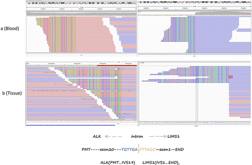 Figure 2 The novel LIMS1-ALK fusion. Sequencing reads of LIMS1 and ALK are shown by the Integrative Genomics Viewer.