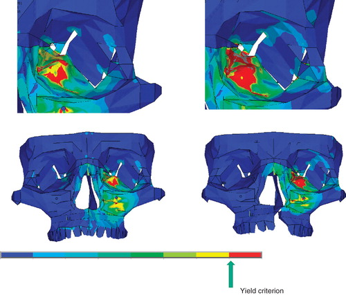 Figure 7.  Representative patterns of the theoretical fracture areas (the areas of the regions where the stresses exceed the yield criterion of the bone: marked with red) for the intact model group (left column) and the cleft model group (right column), respectively.