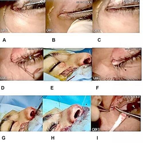 Figure 2 Bicanalicular nasal intubation: (A and B) A punctum dilator was used to enlarge the lacrimal puncti. (C) The proximal lacerated end was located. (D) One head was inserted into the lower canaliculus. (E) It was pulled from the inferior meatus of the nose. (F and G) The other end was placed into the upper canaliculus and pulled out from the nasal cavity by same technique. (H) Tie and trim ends of the tube in the nose. (I) The proximal and distal lacerated ends were subsequently anastomosed with 6\0 absorbable suture and Canalicular edges were approximated using 6\0 vicryl sutures.