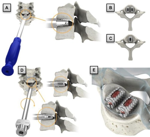 Figure 4 Cervical procedure highlights: (A) sizing and disk opening preparation with cervical tap; (B) bilateral placement; (C) unilateral placement; (D) implant insertion and expansion; and (E) bone graft placement.
