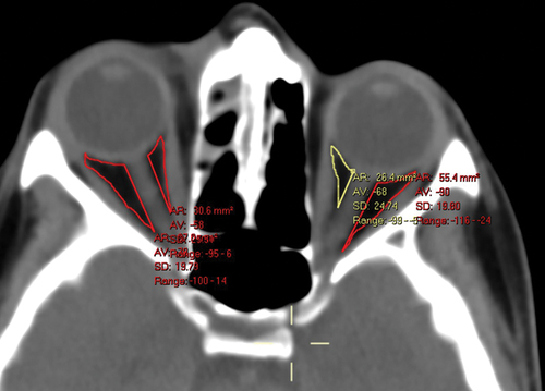 Figure 1. Intraconal orbital fat density as measured in the axial equator plane in a patient with right periorbital cellulitis. The text in the yellow font is automatically extracted from the manually selected area delineated by the yellow surrounding line. AR (area): 26.4 mm2 represents the surface, VA (value): −68 represents the mean hounsfield units (HU) in that area, SD (Standard Deviation): 24.74 represents the standard deviation, and range: −99 to − 3 represents the HU range in that area. The HU were measured for each study participant in 6 separate spaces of the CT scans (nasal and temporal at the axial equator plane, one section above and one below).