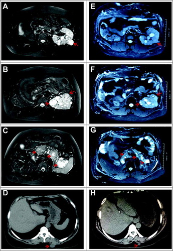 Figure 3. Magnetic resonance imaging (MRI) and computed tomography (CT) scans from Patient 3. The MRI scans show multiple RCCs in the left kidney including RCC in the dorsal of the kidney (A and E), ventral of the kidney and beside the spine (B and F), as well as three pancreatic lesions (C and G) before and after sunitinib treatment. The CT scans show the lesion on her back before and after sunitinib treatment (D and H). Red arrows indicate the masses.