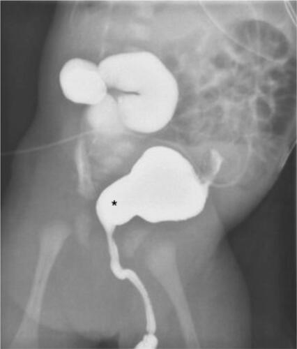 Figure 3 Voiding Cystourethrogram (VCUG) of male infant demonstrating dilated prostatic urethra with classic “key hole” sign secondary to posterior urethral valve. Some upper tract deterioration is already noted on the right given the significant dilatation from increased intravesical pressures.