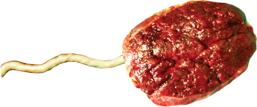 Figure 2 A placenta.