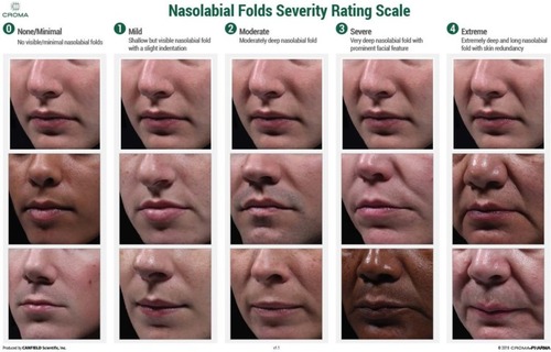 Figure 1 Croma-Pharma nasolabial folds severity rating scale.