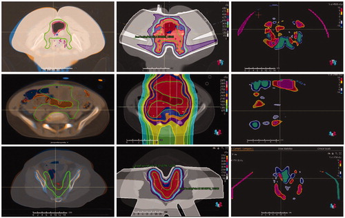 Figure 3. Registered pCT and QACT (left column), dose distribution in the pCT (middle column), and difference in doses in the pCT and QACT (right column) for cases 12 (top row), 17 (middle row), and 14 (bottom row). The CTV contour in the pCT is in solid green, and the dashed green line on the QACT was obtained by DIR. Brown = contour of air in pCT; red = contour of air in QACT.