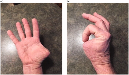 Figure 4. (a,b) Images taken after the third surgery in 2018 showing final functional ability.
