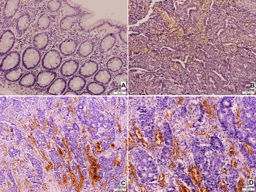 Figure 1 TEM8 expression in normal colonic mucosa and colorectal cancer tissue. (A) Normal colonic mucosa of the surgical margin (free of tumor), no TEM8 expression; (B) colonic adenocarcinoma. Immunohistochemical expression of TEM 8 within endothelial cells of vessels, low expression; (C and D) colonic adenocarcinoma. Immunohistochemical expression of TEM 8 within endothelial cells of vessels, high expression.