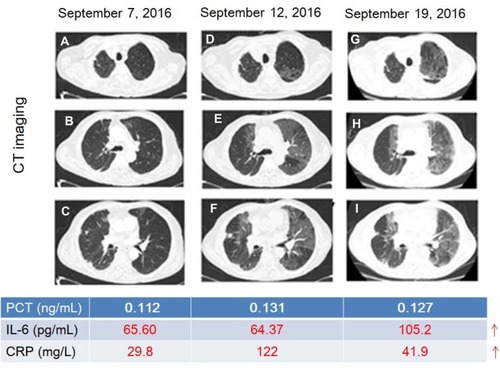 Figure 4 A typical case of the change of cytokines and CT when developed RP. (A–C) mild interstitial changes in the left lung; (D–F), interstitial changes in both lungs; (G–I), the characteristic imaging changes of RP (small ground-glass opacity scattered in the irradiation field or long strip, large patch density enhancement shadow). Red numbers indicate the rise of the level.Abbreviations: CT, computed tomography; IL-6, interleukin-6; CRP, C-reactive protein; PCT, procalcitonin.