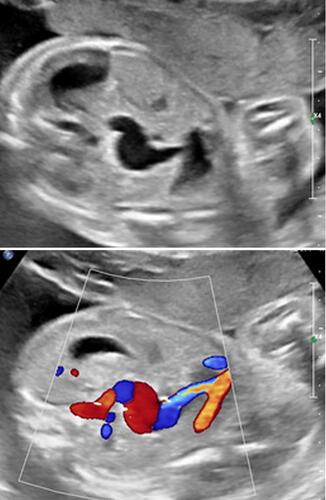 Figure 8 Fetal intra-abdominal varix at 24 and 5/7 weeks’ gestation. Upper panel: Real-time ultrasound depicting the intra-abdominal aneurysmal dilatation of the umbilical vein. Lower panel: Color Doppler imaging confirming the venous vascular nature of this lesion.