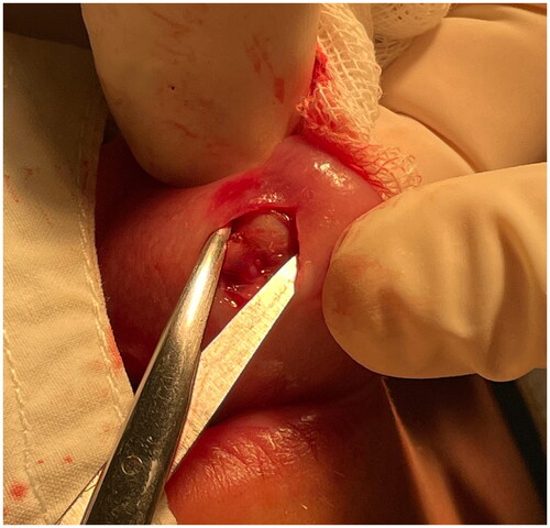 Figure 2. Intraoperative photograph of the cyst.