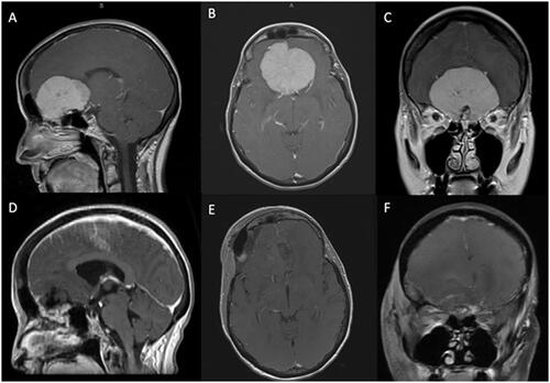 Figure 1. Preoperative sagittal (A), axial (B), and coronal (C) T1-weighted MRI with gadolinium depicting a large OGM with mass effect on the surrounding frontal lobes. The patient underwent a right LSO approach with Simpson grade II resection of the tumor as demonstrated on the postoperative sagittal (D), axial (E), and coronal (F) T1-weighted postcontrast MRI.