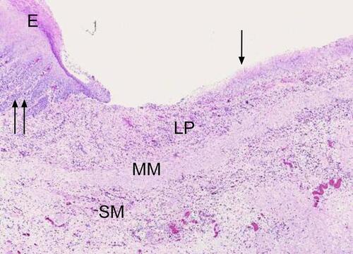 Figure 8 Ulcer (single black arrow) adjacent to normal squamous epithelium. Notice the complete loss of epithelium in the ulcer bed and exposure of the underlying lamina propria. Prominent epithelial projections can be seen in the normal mucosa immediately adjacent to the ulcer (double black arrows). Bar = 1000 μm. Image reproduced with permission of Equine Veterinary Journal. Martineau H, Thompson H, Taylor D. Pathology of gastritis and gastric ulceration in the horse. Part 1: range of lesions present in 21 mature individuals. Equine Vet J. 2009;41(7):638–644.Citation23