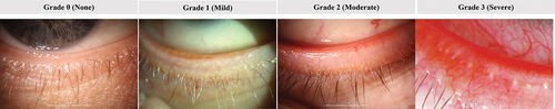 Figure 2. Lid margin erythema grading scale (non-linear). Grade 0: Normal age-related lid coloration; Grade 1: Pink capillary involvement along the lid edge, no patches of confluent capillary redness throughout the lid edge; Grade 2: Deep pink or red confluent capillary redness present locally along the lid edge; Grade 3: Deep red, diffuse confluent capillary redness present along the lid edge.