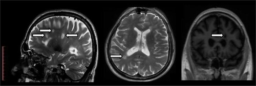 Figure 1 MRI sections showing multiple demyelinating brain lesions (arrows).