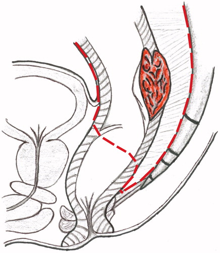 Figure 1. The extent of the total mesorectal excision.