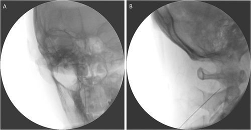 Figure 2 Radiographs showing the correct placement of the needle tip for C2 DRG. (A) Anteroposterior fluoroscopy view shows that the needle tip is located at middle of the lateral AA joint. (B) Lateral fluoroscopy view shows that the needle is located on the surface of the lateral AA joint.
