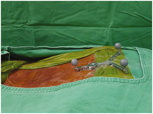 Figure 3. Lateral picture of the skin fixed DRF on the area between iliac crest line and integluteal cleft.