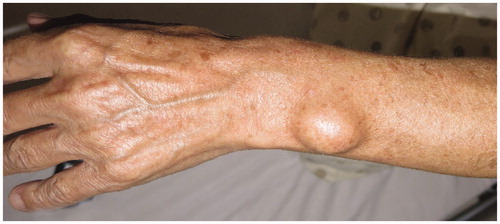Figure 1. Preoperative physical examination. The swelling was elastic and hard. There was no scar and no central punctum.
