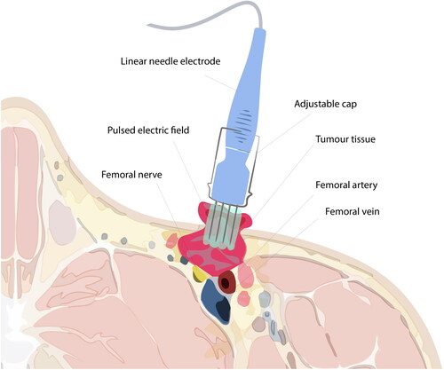 Figure 3. Illustration of electroporation treatment of superficial inguinal tumour. Electroporation is conducted subsequently after calcium injection of the tumour and margin area. The electrode, at full length (3 cm), cannot reach the most profound parts of the tumour. Caution is required during treatment due to the anatomical structures, e.g. the femoral vein, nerve, and artery, adjacent to the tumour tissue. Note: Exaggerated dimensions, features and anatomical structures for illustration purposes in this image, which is not an exact representation of the patient.