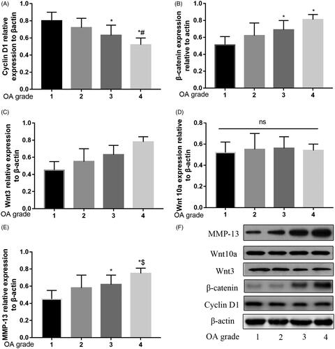 Figure 1. Relative expression of β-catenin, Wnt3, Wnt10a, Cyclin D1 and MMP-13 in different OA grade. Relative expression of Cyclin D1 decreased by grade of OA (A). Relative expression of β-catenin (B), Wnt3 (C) and MMP-13 (E), increased by grade of OA. No significant difference in Wnt10a between the different OA grade (D). Western blot analysis over the expression of these proteins by grade of OA (F).
